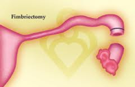 Fimbriectomy 1 Fimbriectomy 1