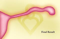 Fimbriectomy 2 Fimbriectomy 2