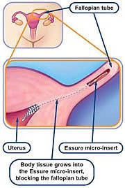 Implanted Essure Coils