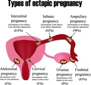 Ectopic pregnancy