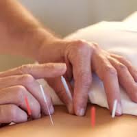 acupuncture